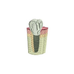 TOOTH IMPLANT